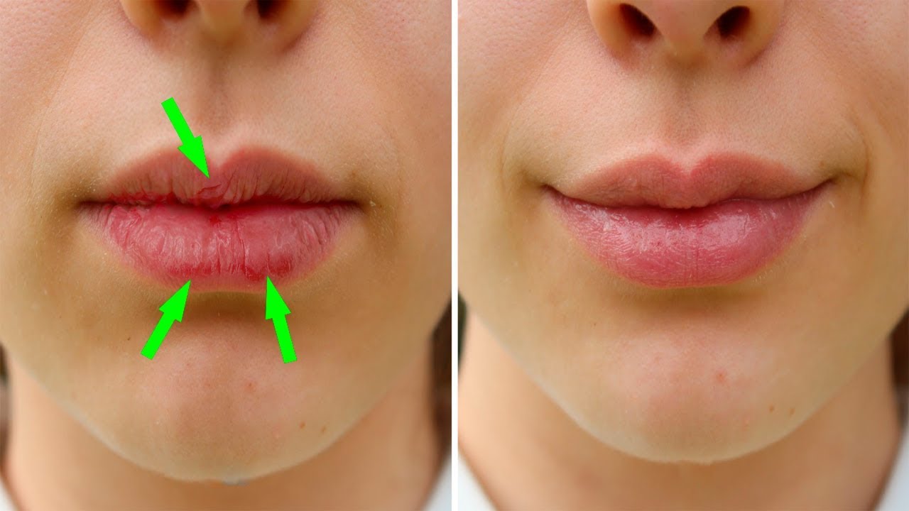 Dry Chapped Lips Treatment in Delhi